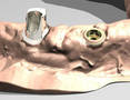 Dental Component Machining Software adds 5-axis options.