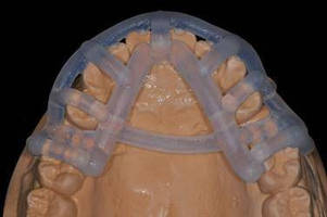 Stratasys 3D Printing Improves Accuracy of Dental Implant Surgery