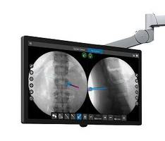 New SpineMap Go Software Provides Intraoperative Image Guidance for Spinal Surgery