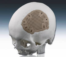 First Use of Laser-Sintered PEEK for Craniofacial Implants